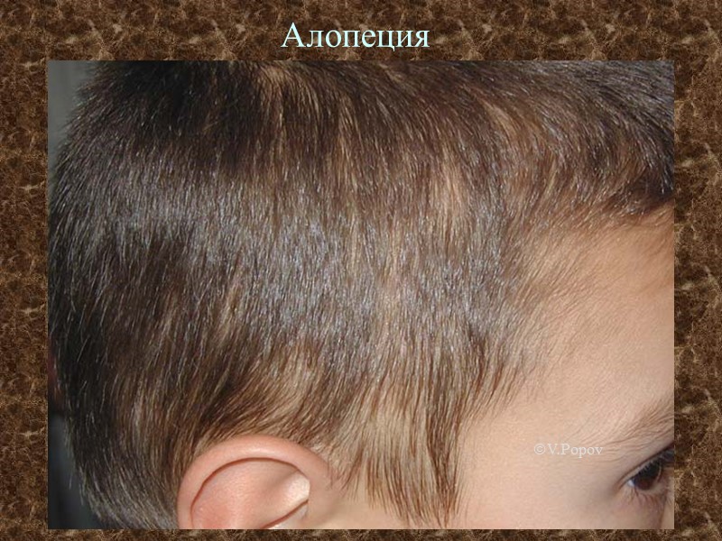 Алопеция г V.Popov